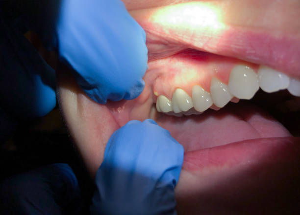 Best Emergency Dental Care for Broken or Chipped Teeth in Steamboat Springs, CO